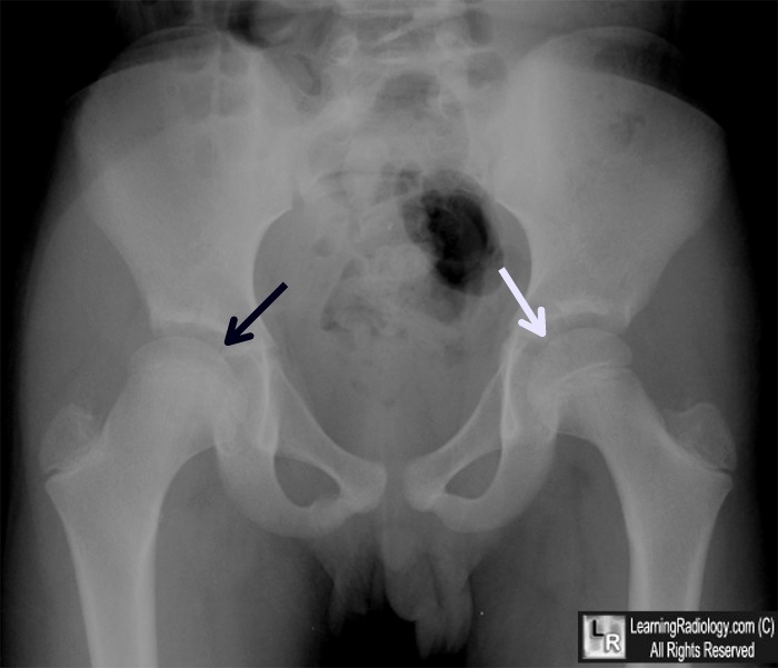 legg calve perthes disease